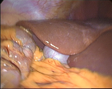 liver and gall bladder liver and gall bladder